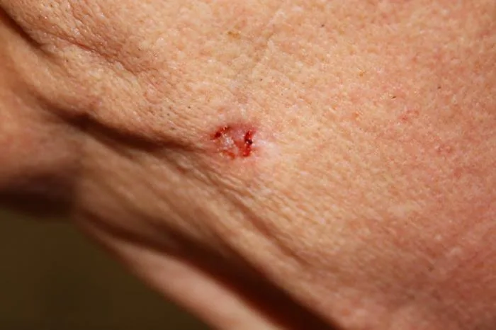 Carcinoma basocelular na face, como pápula elevada de aspecto perolado com crosta na superfície