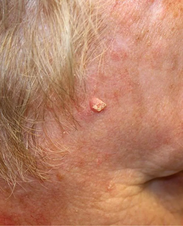 Carcinoma espinocelular em pele com dano solar, como lesão endurecida com ferida que não cicatriza