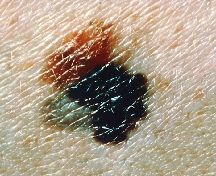 Melanoma com assimetria, bordas irregulares e mais de uma cor na mesma lesão