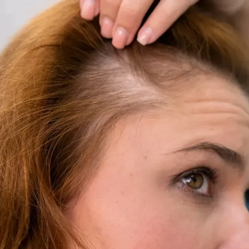 Queda de cabelo em mulher, com alargamento da risca central